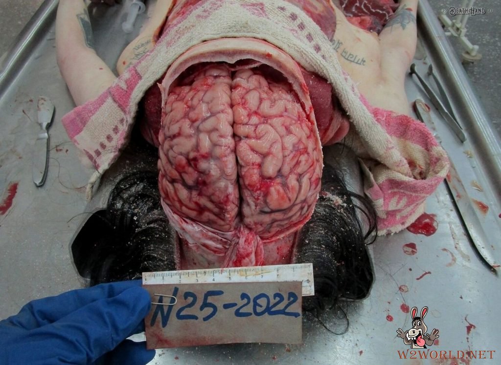 Young woman's autopsy