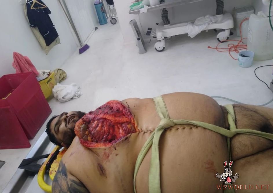 Obese man autopsy photos