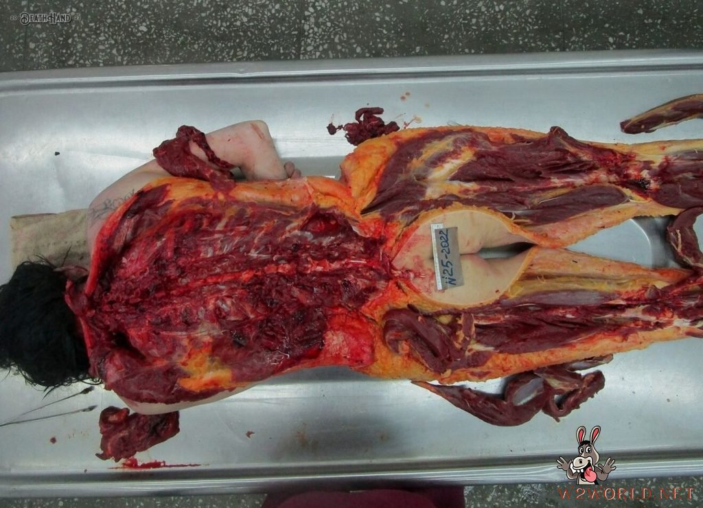 Young woman's autopsy