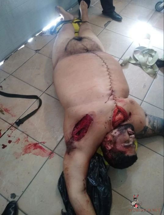 Obese man autopsy photos