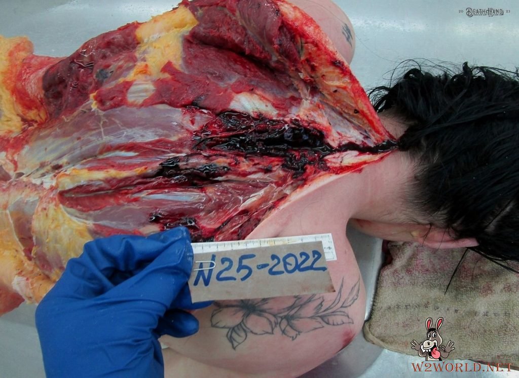 Young woman's autopsy