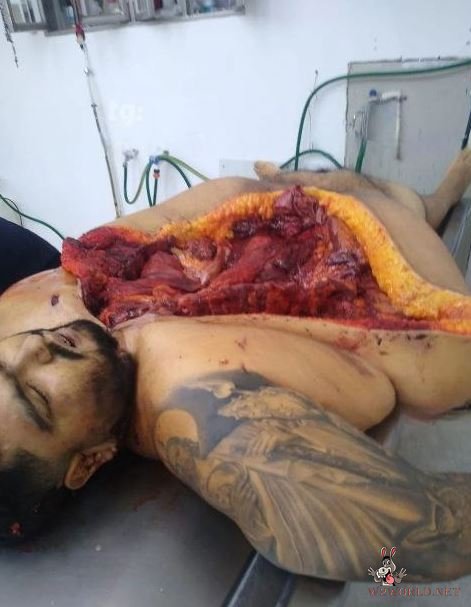 Obese man autopsy photos