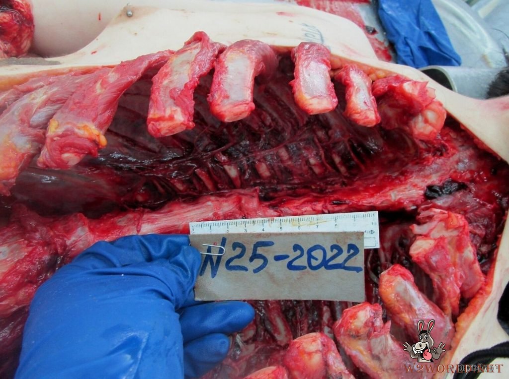 Young woman's autopsy