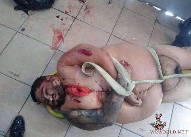 Obese man autopsy photos