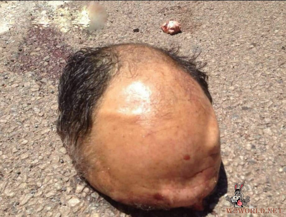 Man dismembered in accident