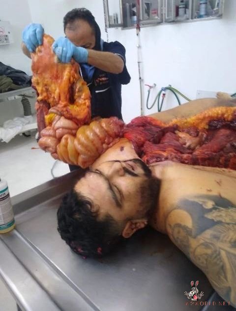 Obese man autopsy photos
