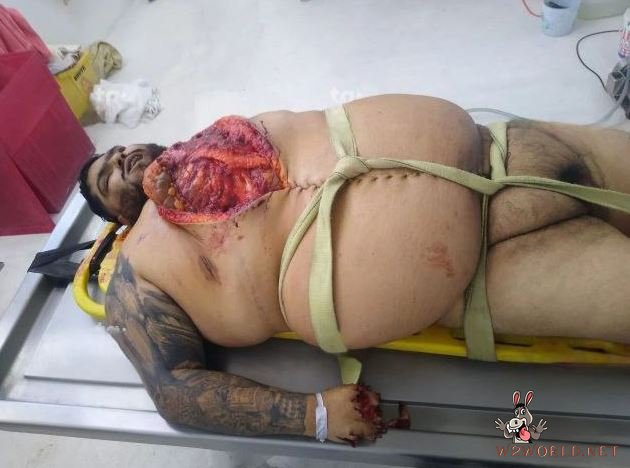 Obese man autopsy photos