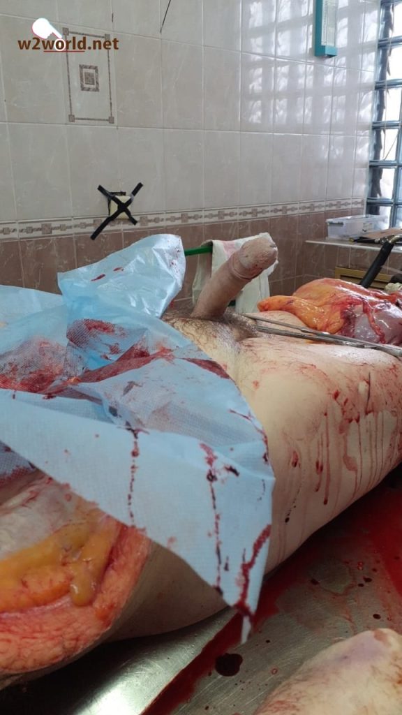 male corpse with erect penis