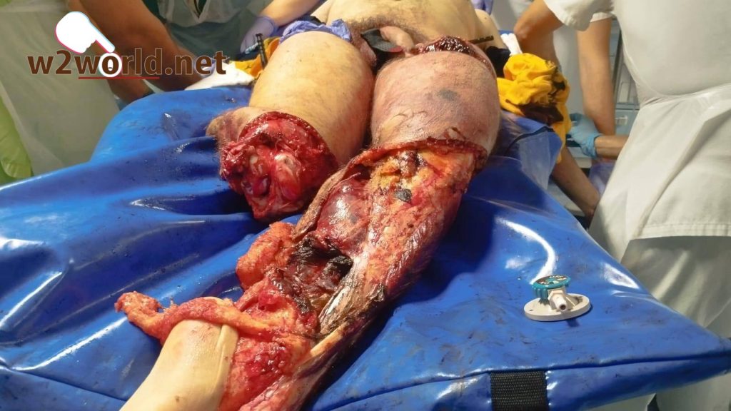 Train crushes man's leg