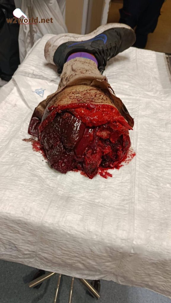 leg severed by train