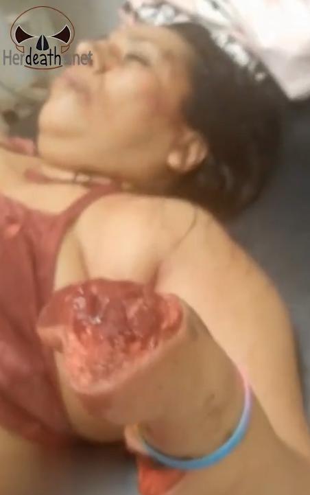 Woman’s Left Hand Severed in Brutal Machete Attack by Partner in Fogones Río de Oro, Manabí