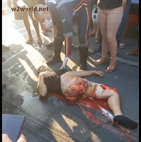 leg torn off in accident