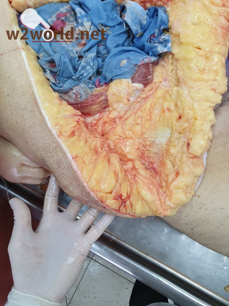 Funeral Workers' Gruesome Task: Removing Excess Fat from Obese Corpses to Fit Caskets 01