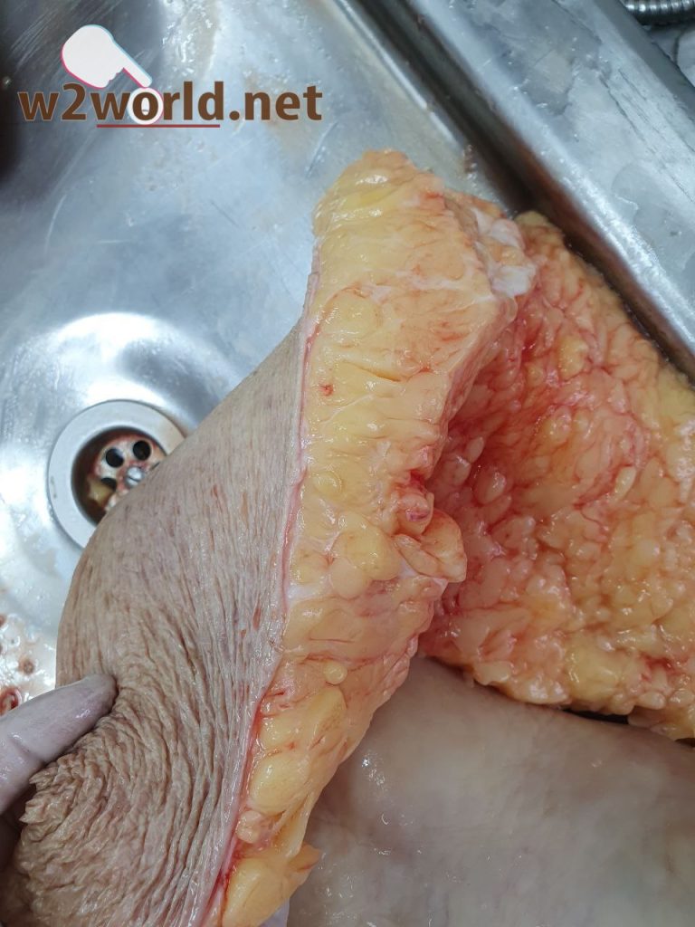 Funeral Workers' Gruesome Task: Removing Excess Fat from Obese Corpses to Fit Caskets 02