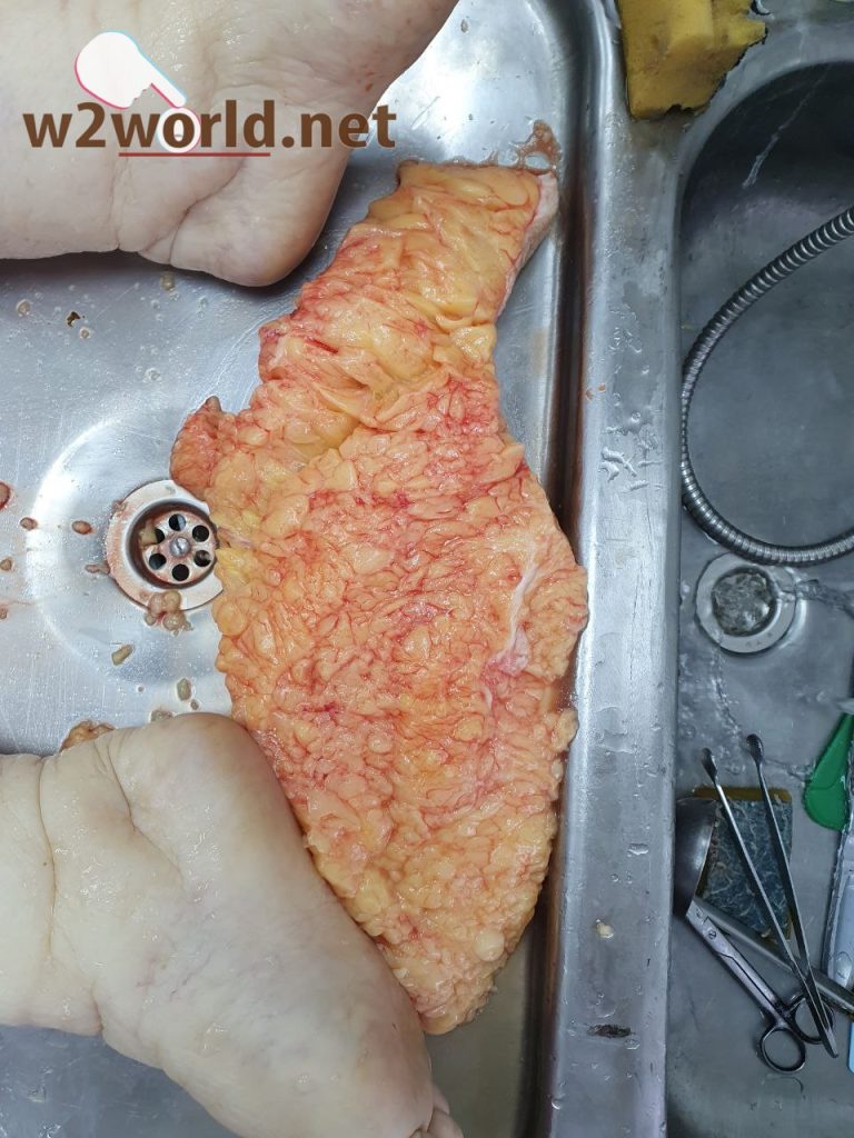 Funeral Workers' Gruesome Task: Removing Excess Fat from Obese Corpses to Fit Caskets 04