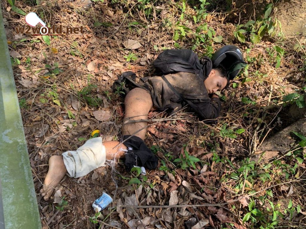 One Suffers Traumatic Leg Amputation 03