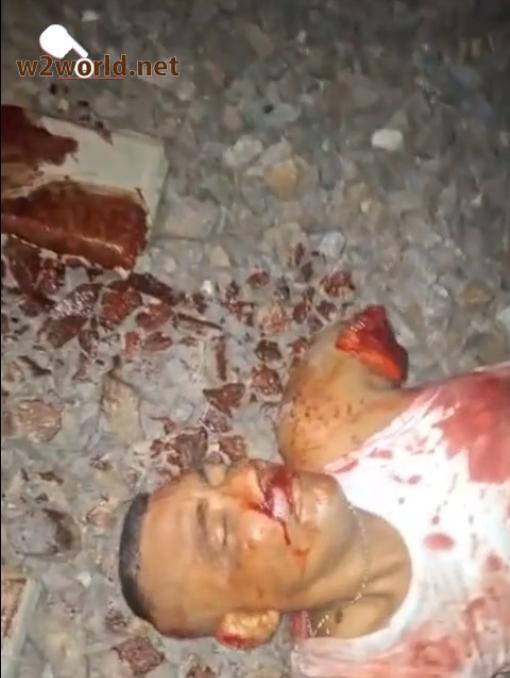 He lost an arm and is in pain