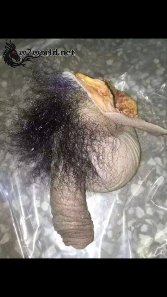 Penises are amputated because their owners no longer need them 04