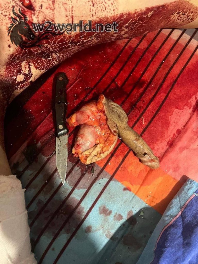 Woman Weighing 140kg Bites Off Man's Penis After Being Called Fat, Victim Dies Weeks Later 01