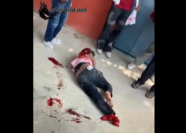 One arm and one leg were lost in the accident