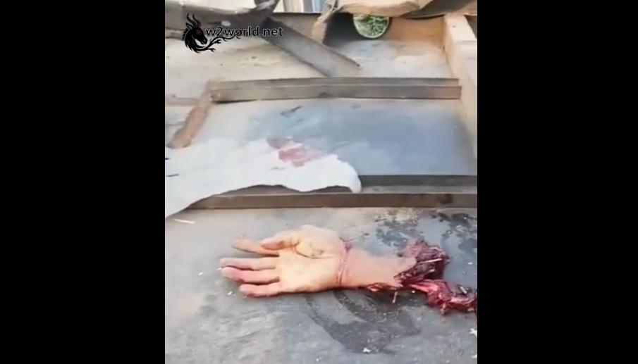 The hand was severed in a serious accident