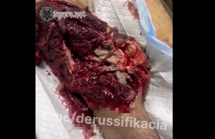 The Soldier with major injuries is being treated