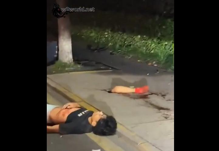 The young man lost a leg in an accident