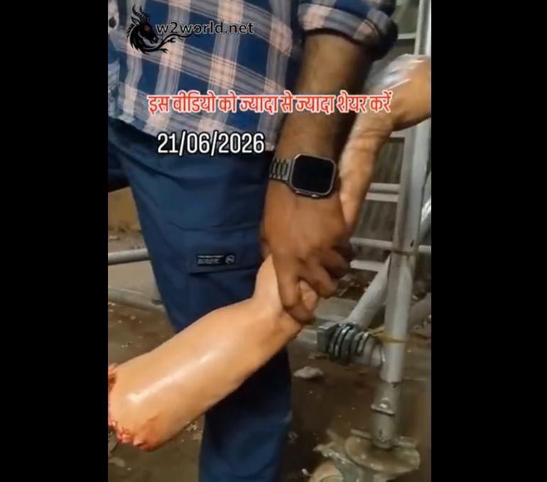 The arm was severed in a work accident