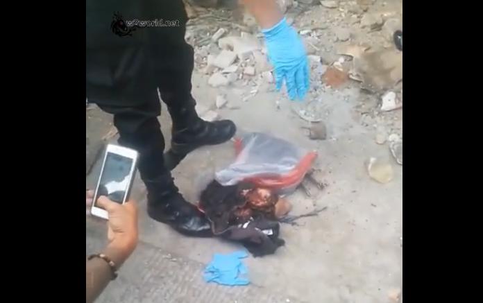 One leg was amputated in a car accident