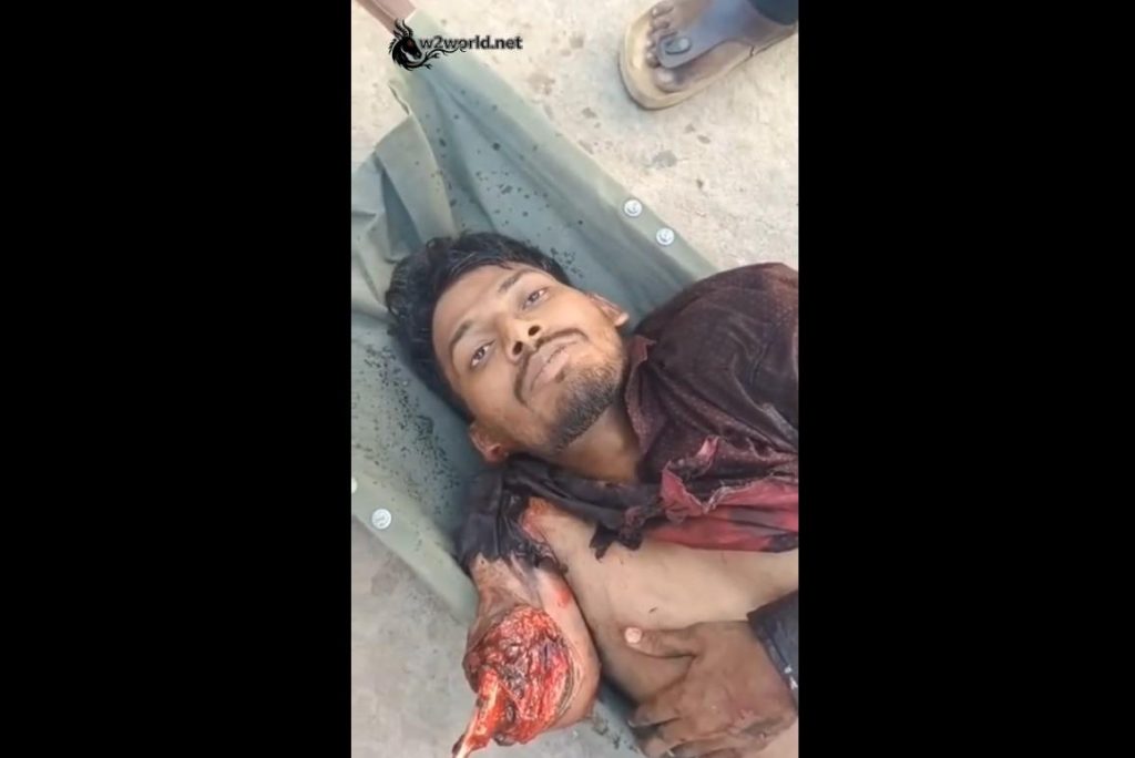 The man was in shock after losing one of his arms